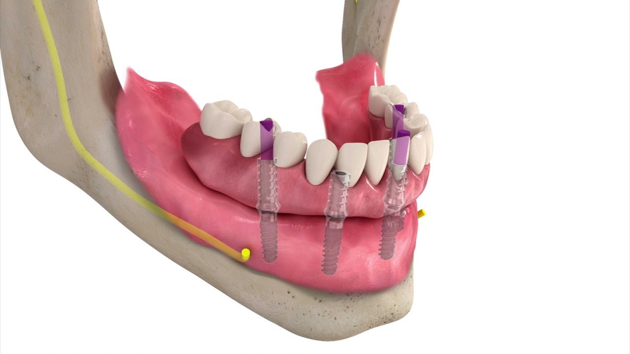 Straumann® Pro Arch TLX step-by-step workflow animation