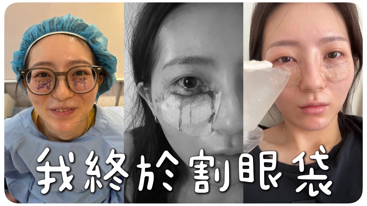 我去做眼袋內開手術🎉我在韓國還是台灣做手術❓中途大量出血🩸費用/恢復期/術後保養 눈밑 지방 재배치 수술 [中/한국어 자막] ｜MENG 맹결 孟潔