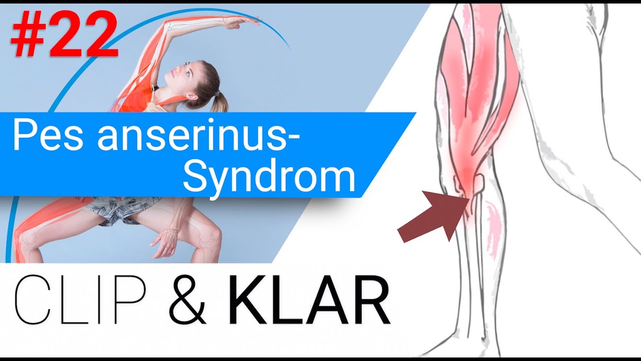 Pes anserinus-Syndrom erklärt - Überlastung der Knie-Innenseite