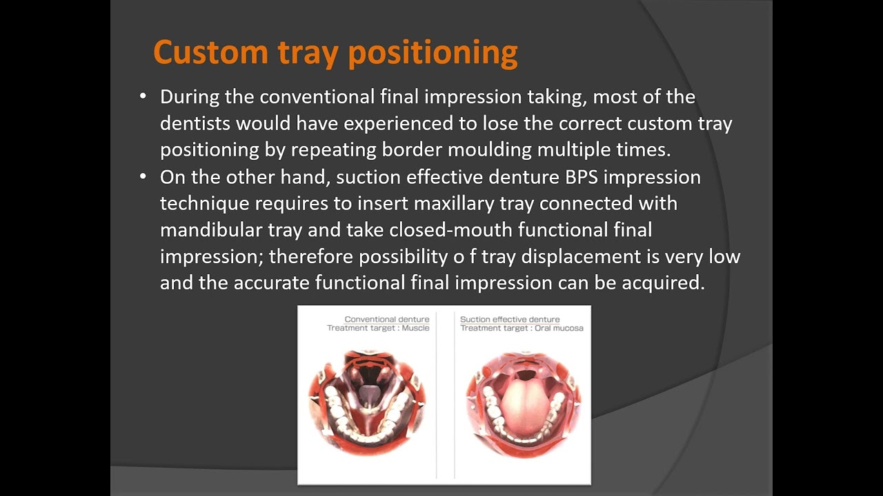 suction denture