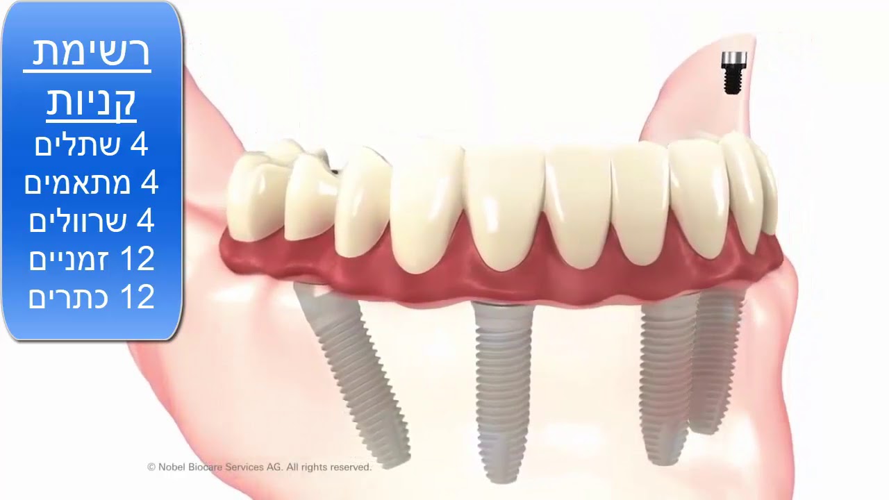 כמה עולה השתלת שיניים אול און פור
