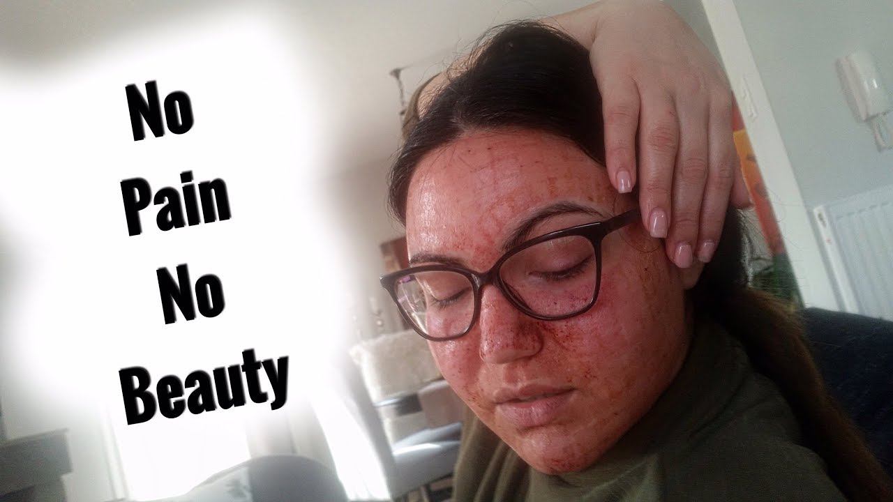 Κάνω Fractional Laser | Review | Onyourface byEfi
