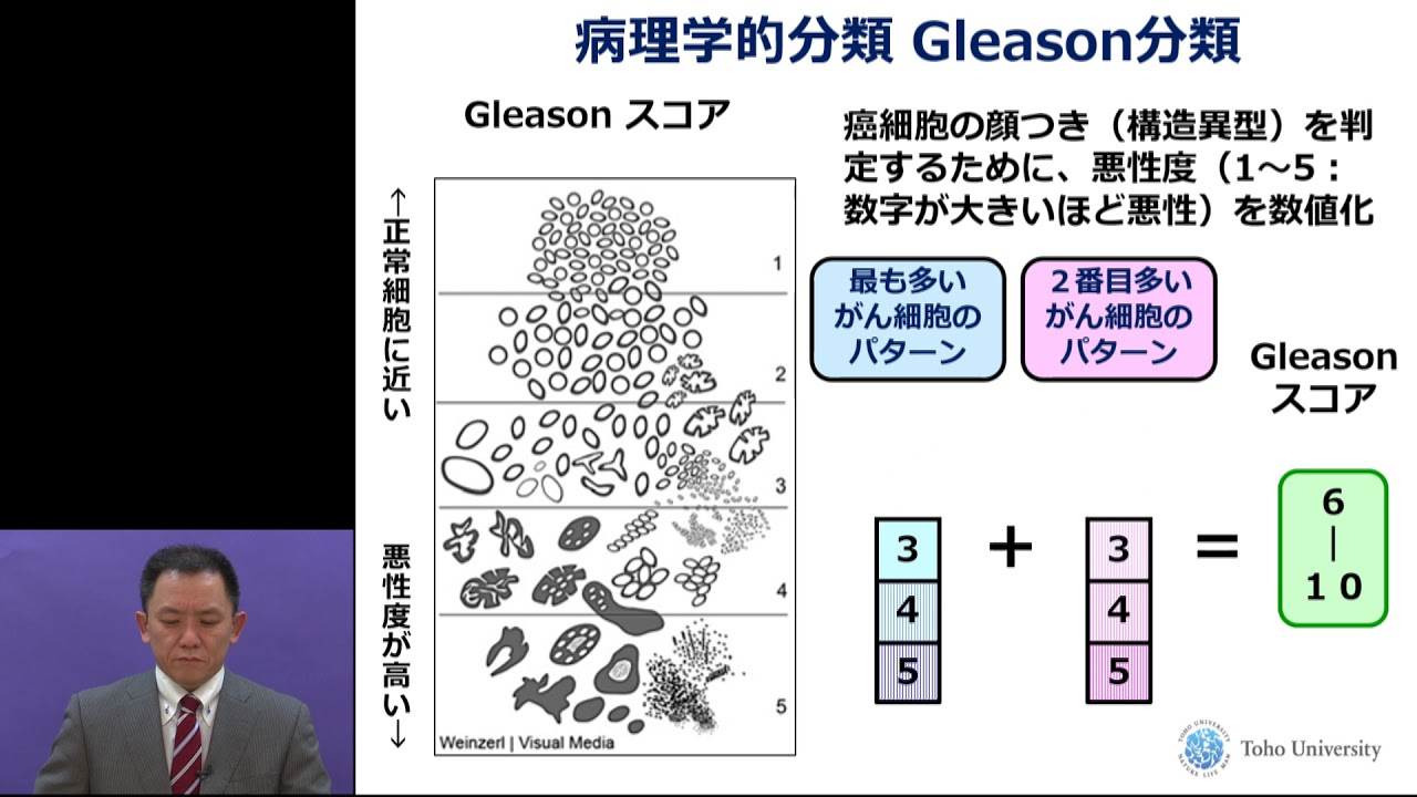 前立腺癌の診断〜リスク分類とノモグラムについて〜　神谷 直人