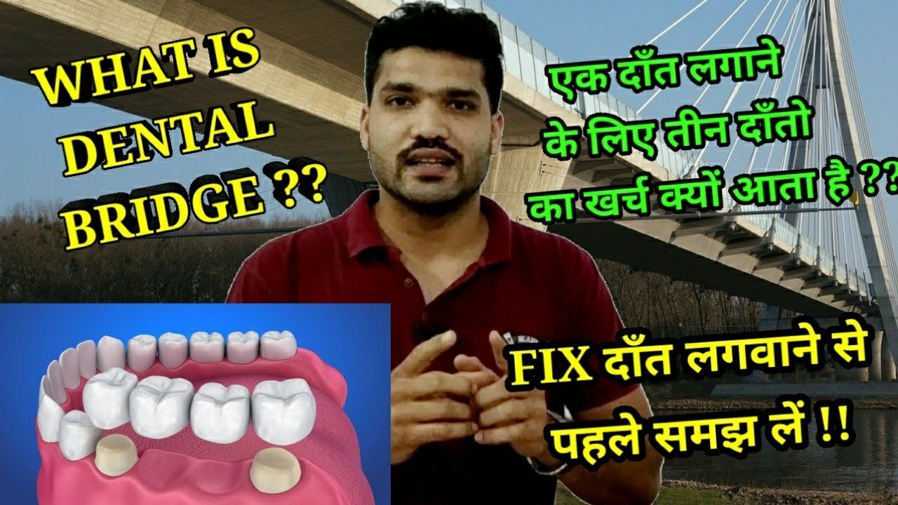 Fixed दाँत कैसे लगाये जाते है ? Dental bridge ?? Tooth supported fixed Bridge ??