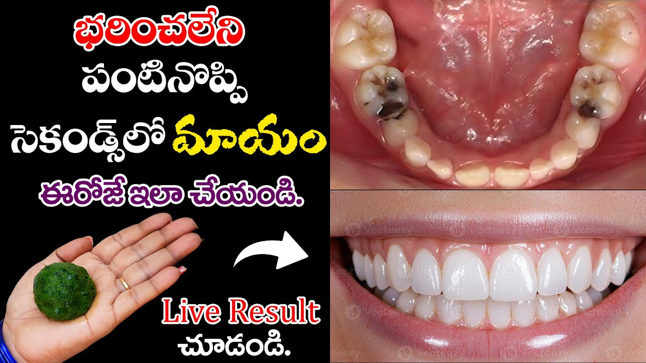 “భరించలేని పంటి నొప్పి క్షణాల్లో మాయం 🦷✨ | Yellow Teeth Instantగా White అవుతాయి 🌿”