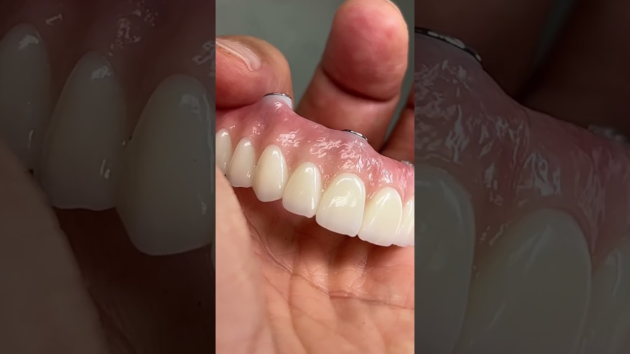 Great All-On-4 Zirconia