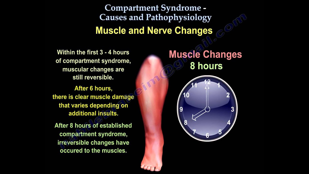 Compartment Syndrome Causes & Pathophysiology - Everything You Need To Know - Dr. Nabil Ebraheim
