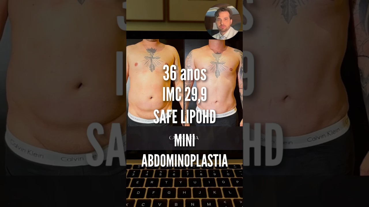 Pré e pós-operatório paciente masculino de uma lipoHD #cirurgiaplástica #estetica