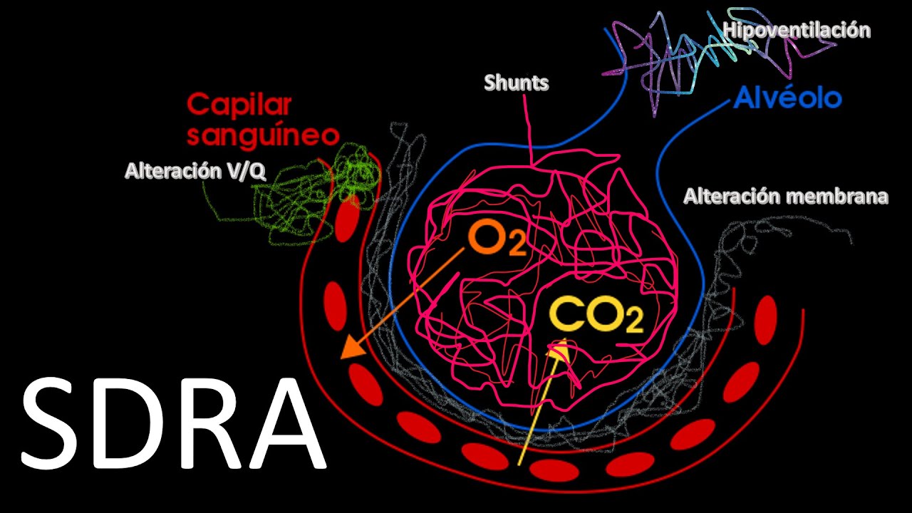 SINDROME DE DISTRES RESPIRATORIO AGUDO