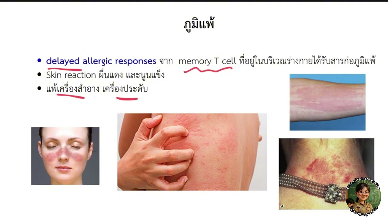 ระบบภูมิคุ้มกัน 4 จบบท (ความผิดปกติของระบบภูมิคุ้มกัน)