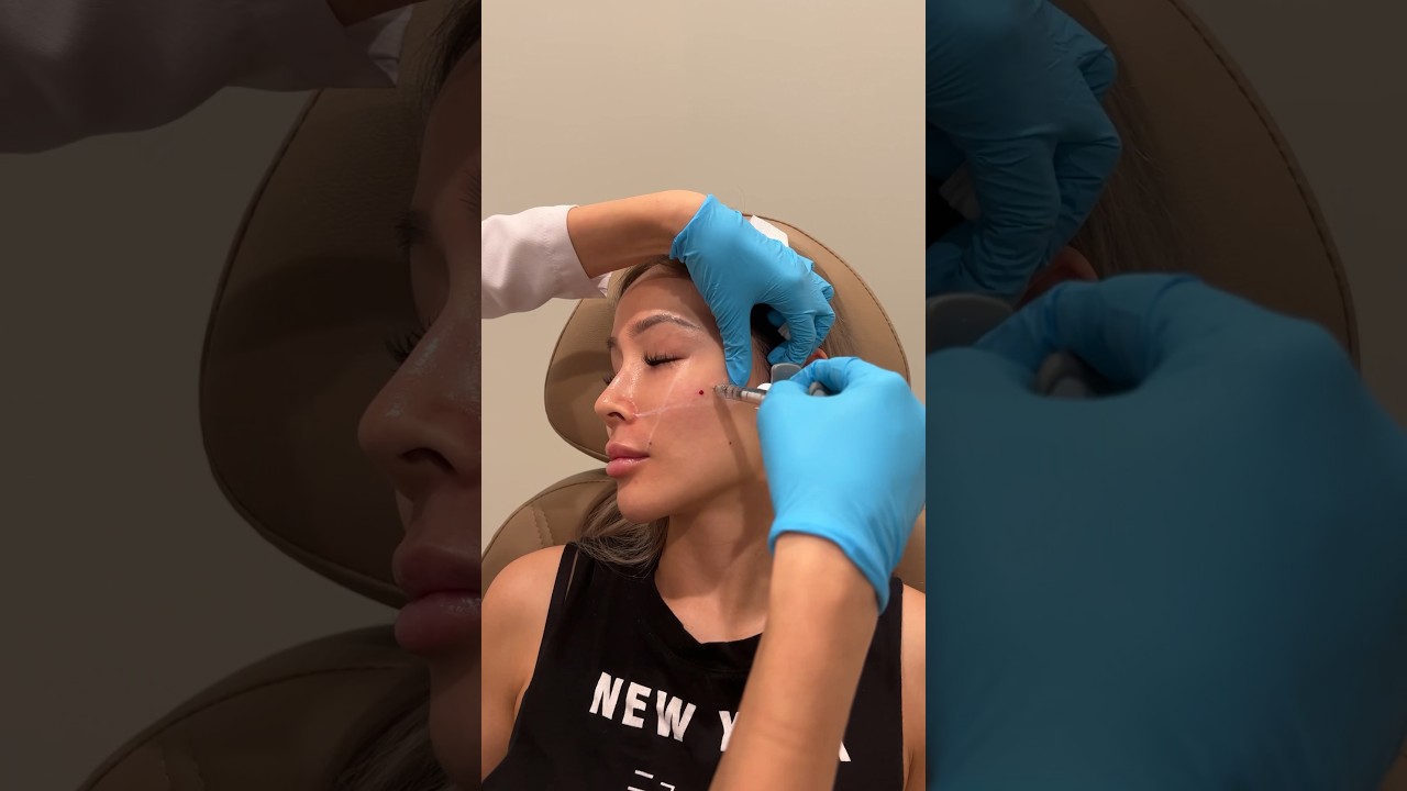 Botox, Lip Filler, & PRF #injectables #medspa