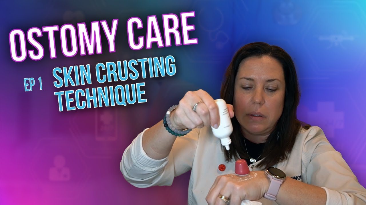 Episode 1: Treating Peristomal Skin Irritation - The Skin Crusting Technique