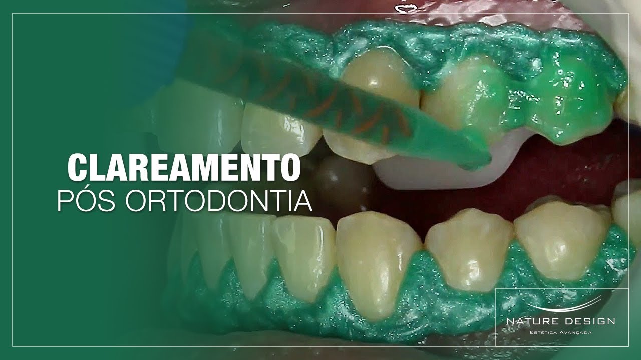 Clareamento Pós Ortodontia | Leonardo Muniz