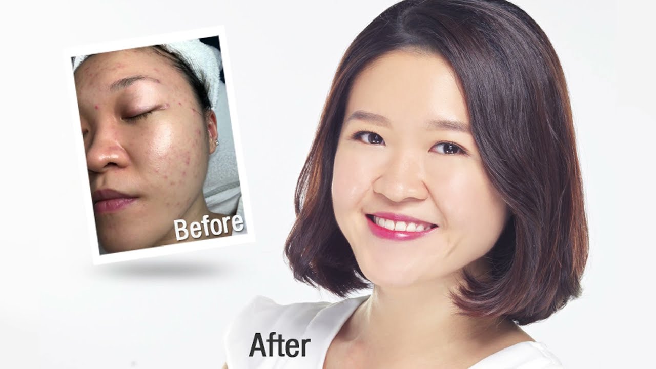[Customer Review] - New York Skin Solutions' Approach to Addressing Teenage Acne & Sensitive Skin
