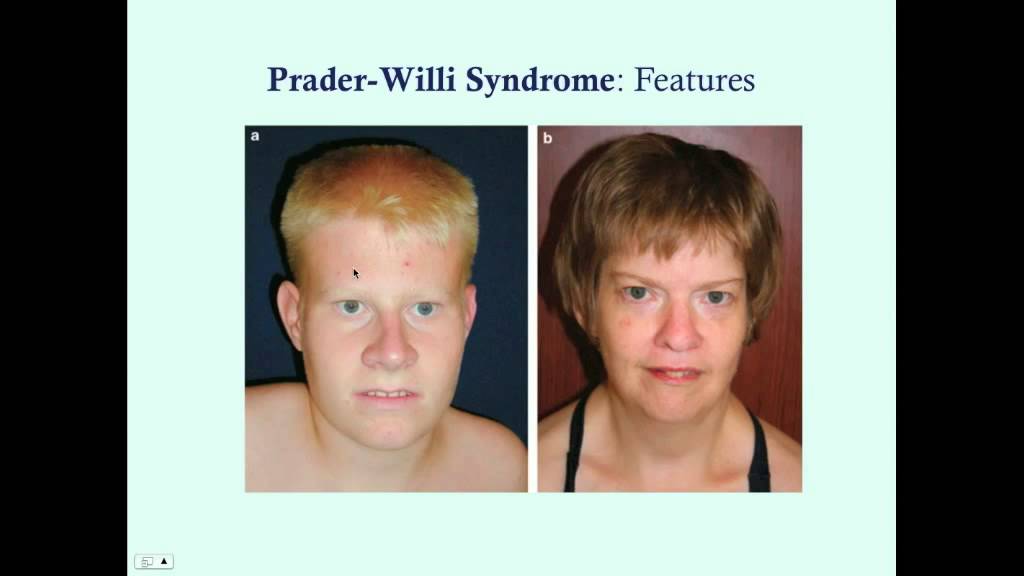 Prader-Willi Syndrome - CRASH! Medical Review Series