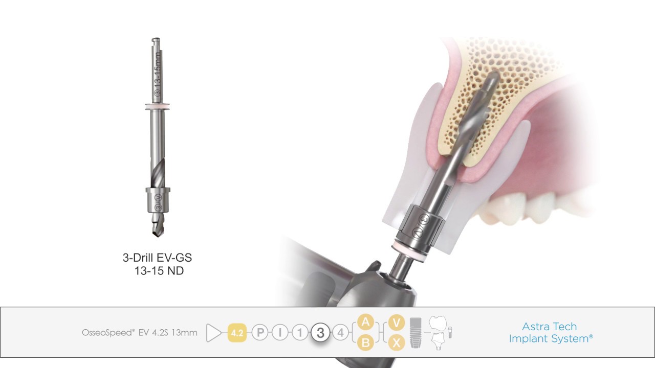 Guided surgery Astra Tech Implant System ® EV