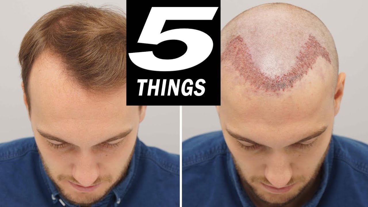 5 THINGS to do after HAIR TRANSPLANT!