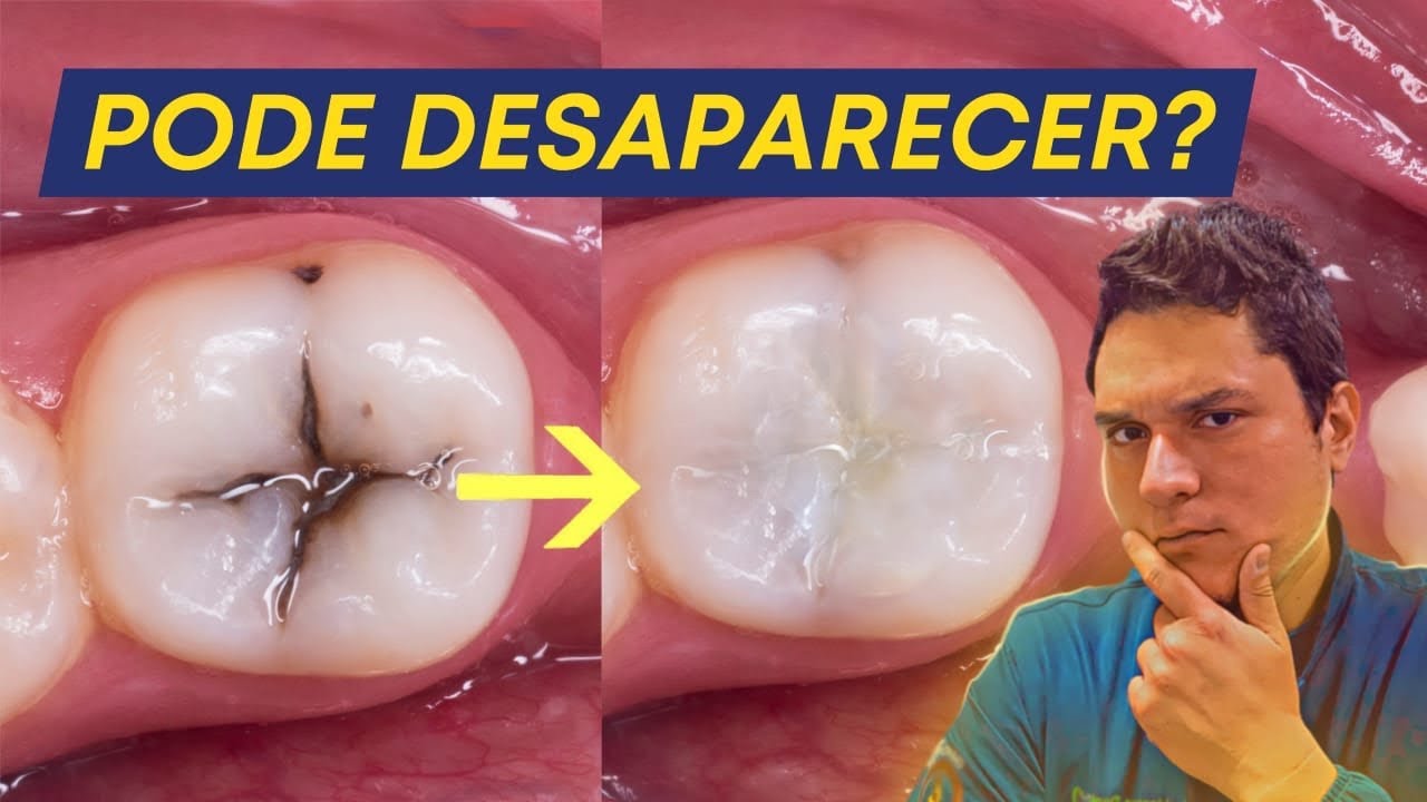 É POSSÍVEL A CÁRIE DESAPARECER SOZINHA?