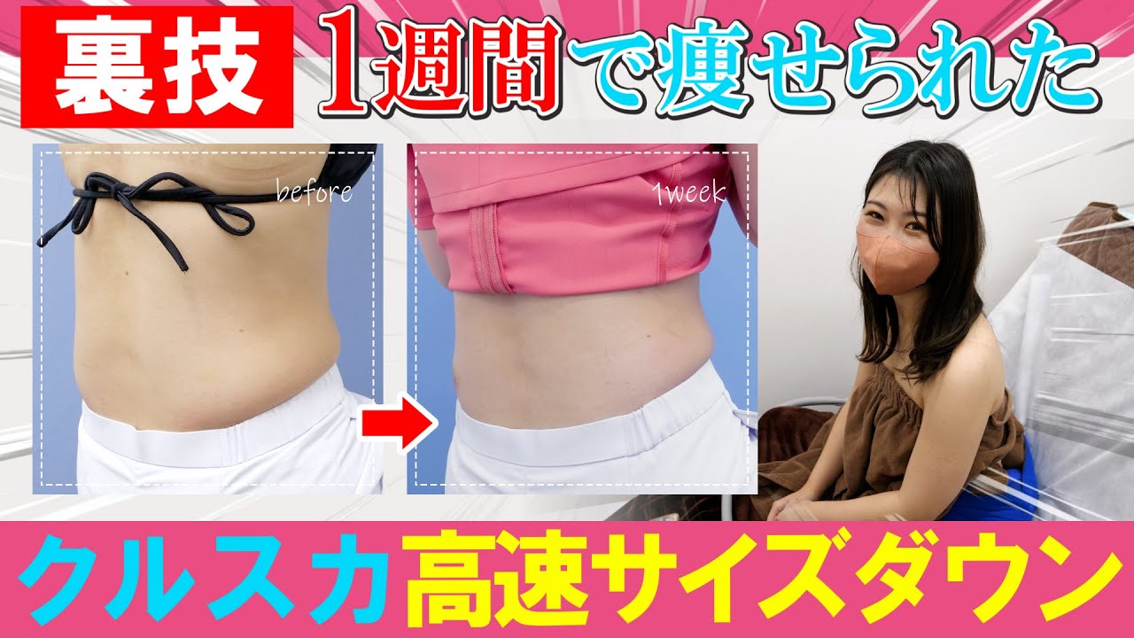 【1週間で痩せたい】脂肪冷却クルスカダブルの裏技で速攻サイズダウンした【リポフラ＆山参注射】湘南美容クリニック