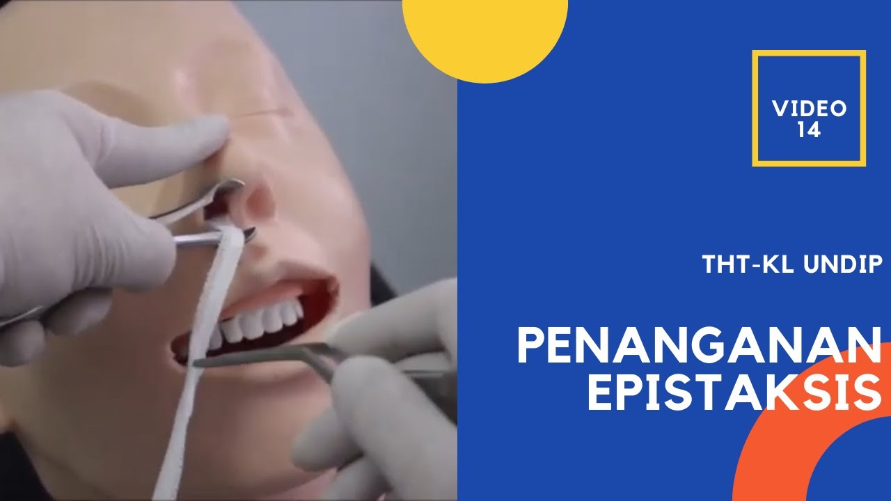 Penanganan Epistaksis