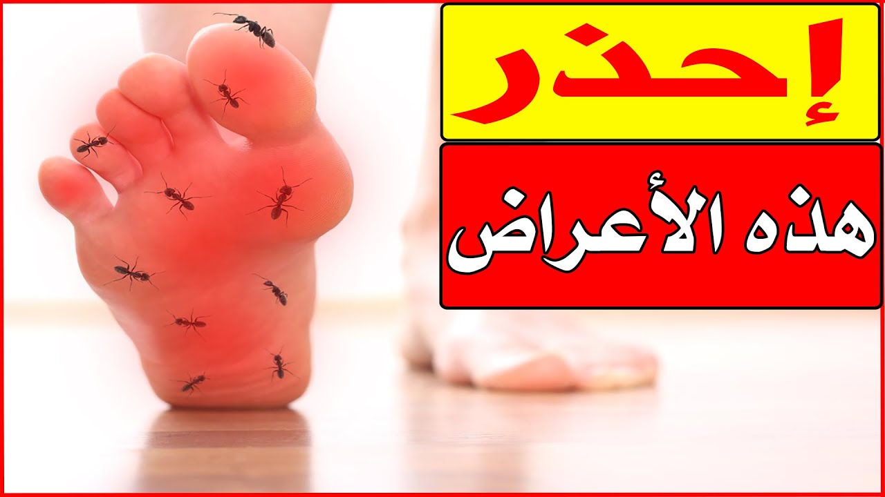إحذر الم وتنميل وحرقان باطن القدم والكعبين السبب والعلاج/أ.د.محمد حمادة أستاذ علاج الألم بطب الازهر