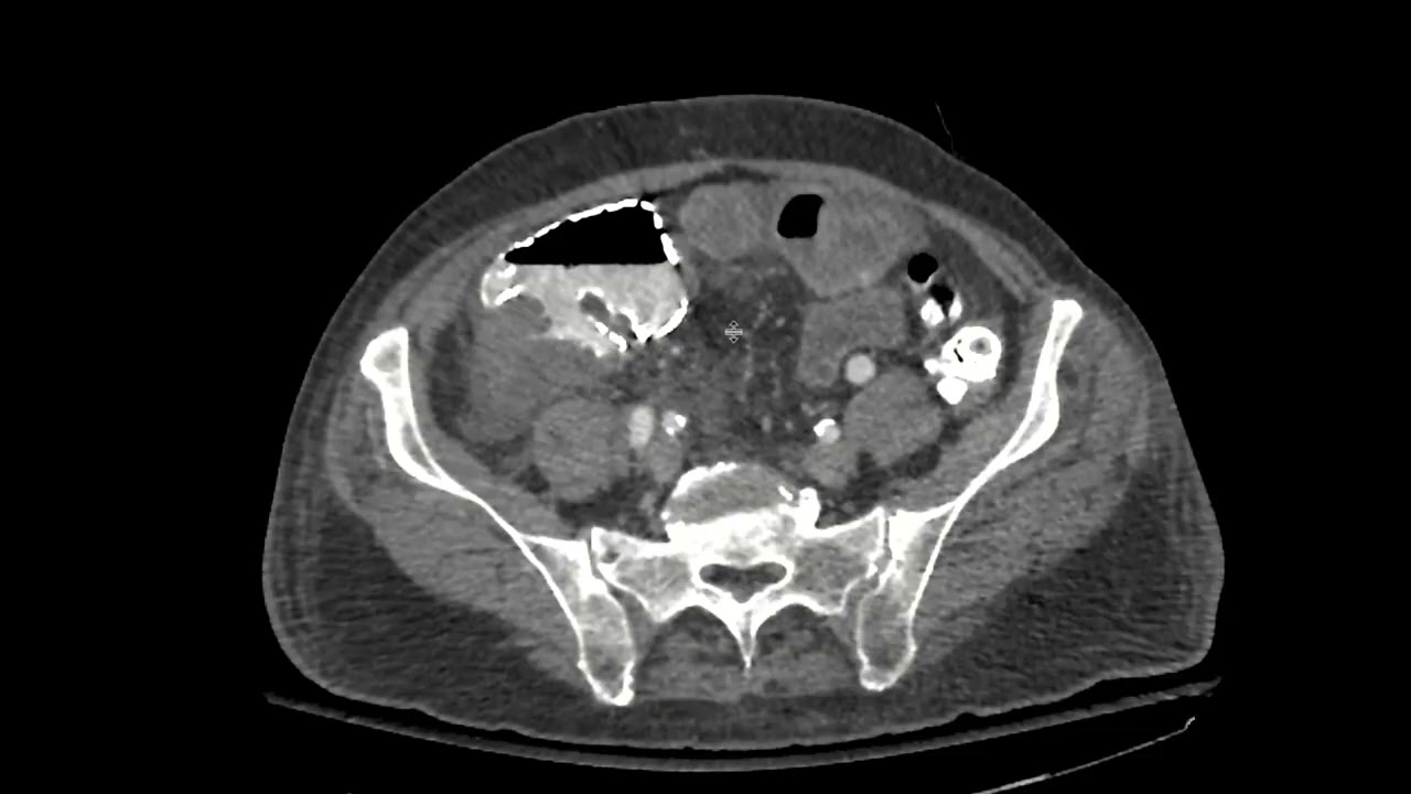CT findings of suspected bowel ischemia
