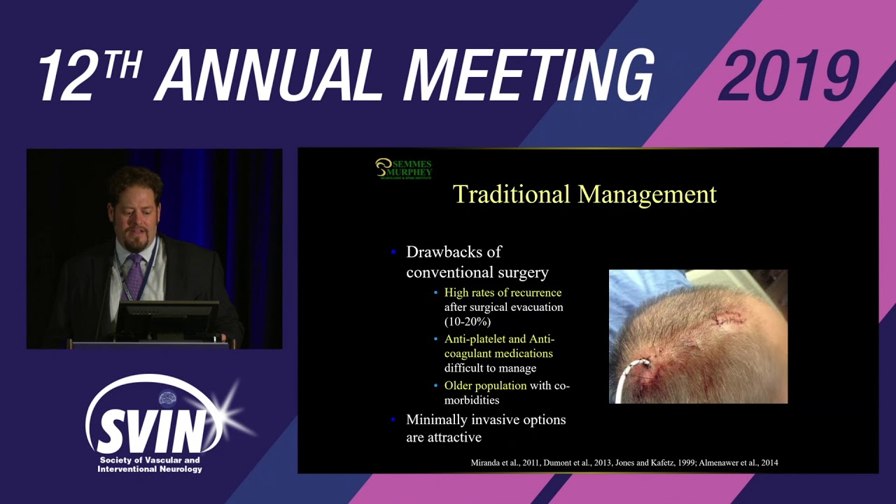 SVIN 2019: MMA Embolization for Subdural Hematoma