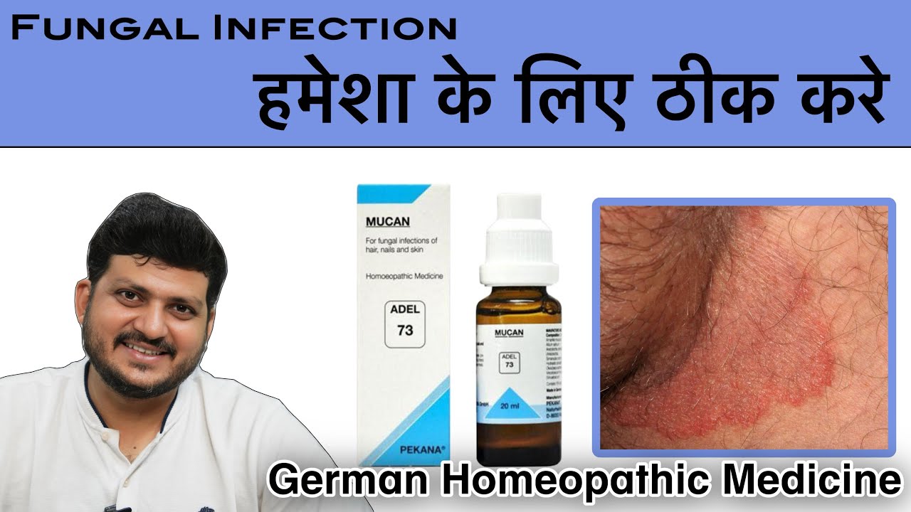 Fungal Infection अब जड़ से खत्म होगा ? German Homeopathic Medicine | ADEL 73 |