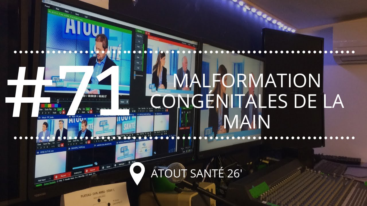 [ATOUT SANTE #71] Les malformations congénitales de la main