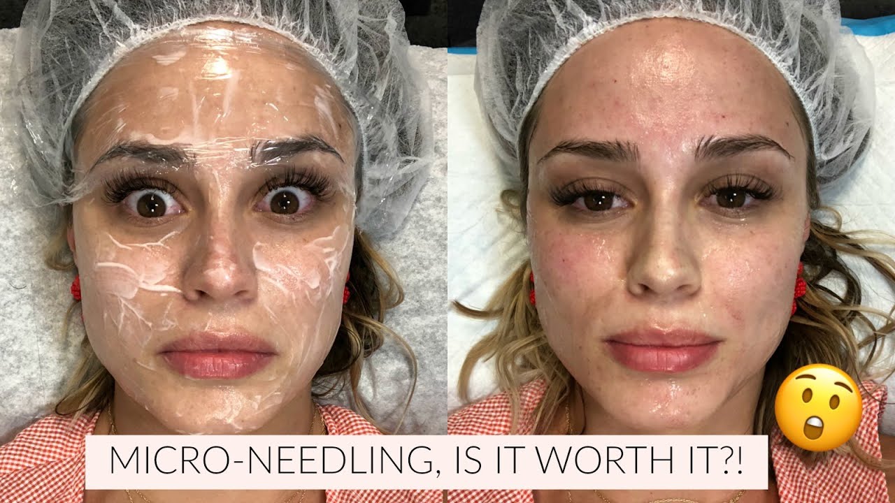Micro-Needling Experience