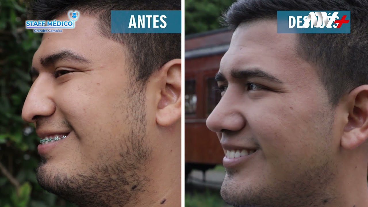 👃🏻 RINOSEPTOPLASTÍA CERRADA ULTRASÓNICA / Dr. Norman Anco, cirujano plástico.