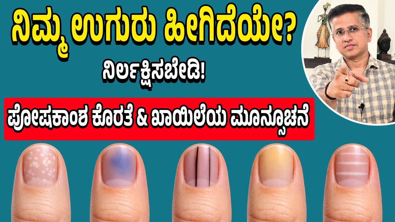 Nails Sign of Health Disease | Finger clubbing | Signs of anemia \ ಉಗುರು ನೋಡಿ.. ಕಾಯಿಲೆ ಪತ್ತೆ ಹಚ್ಚಿ!