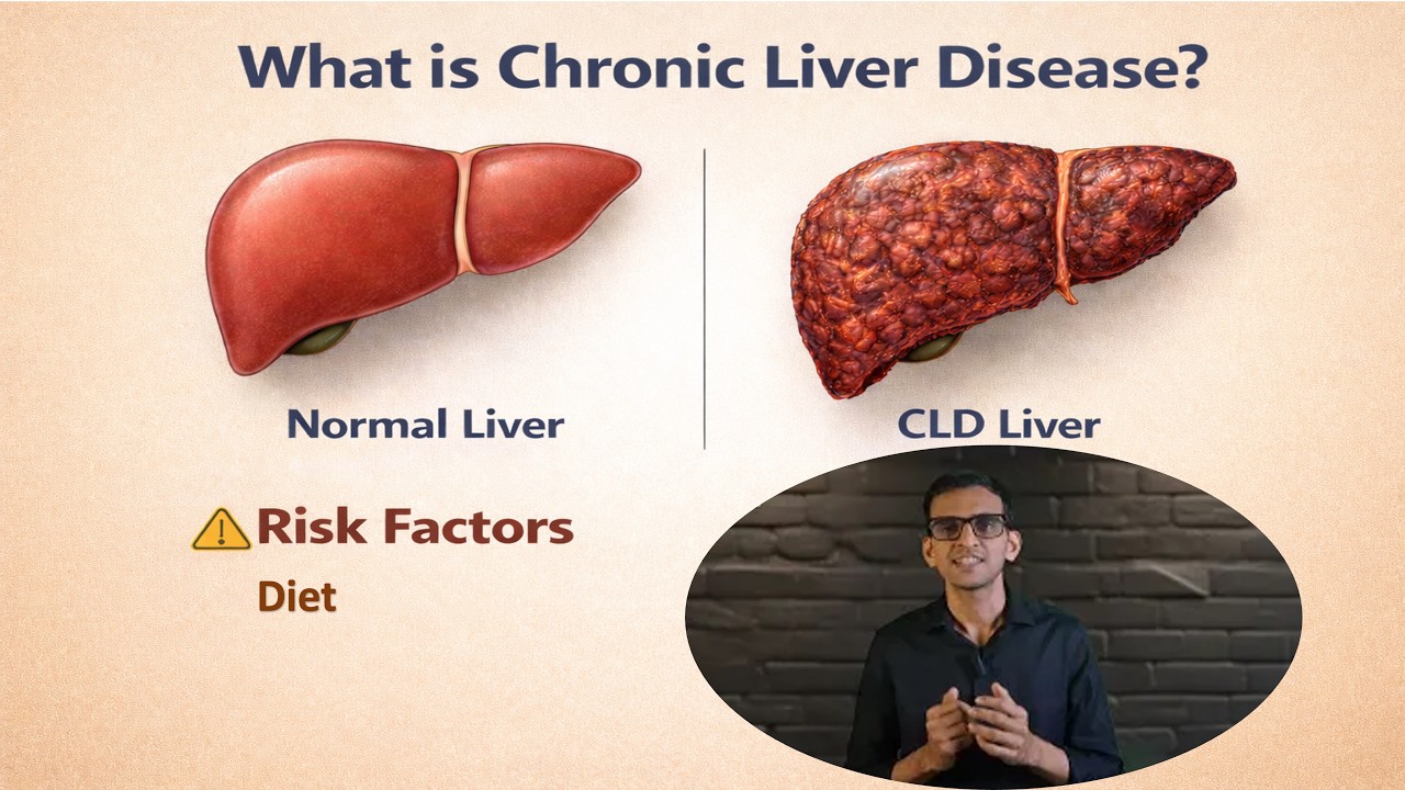 Chronic liver disease #cld #risk factors#diet