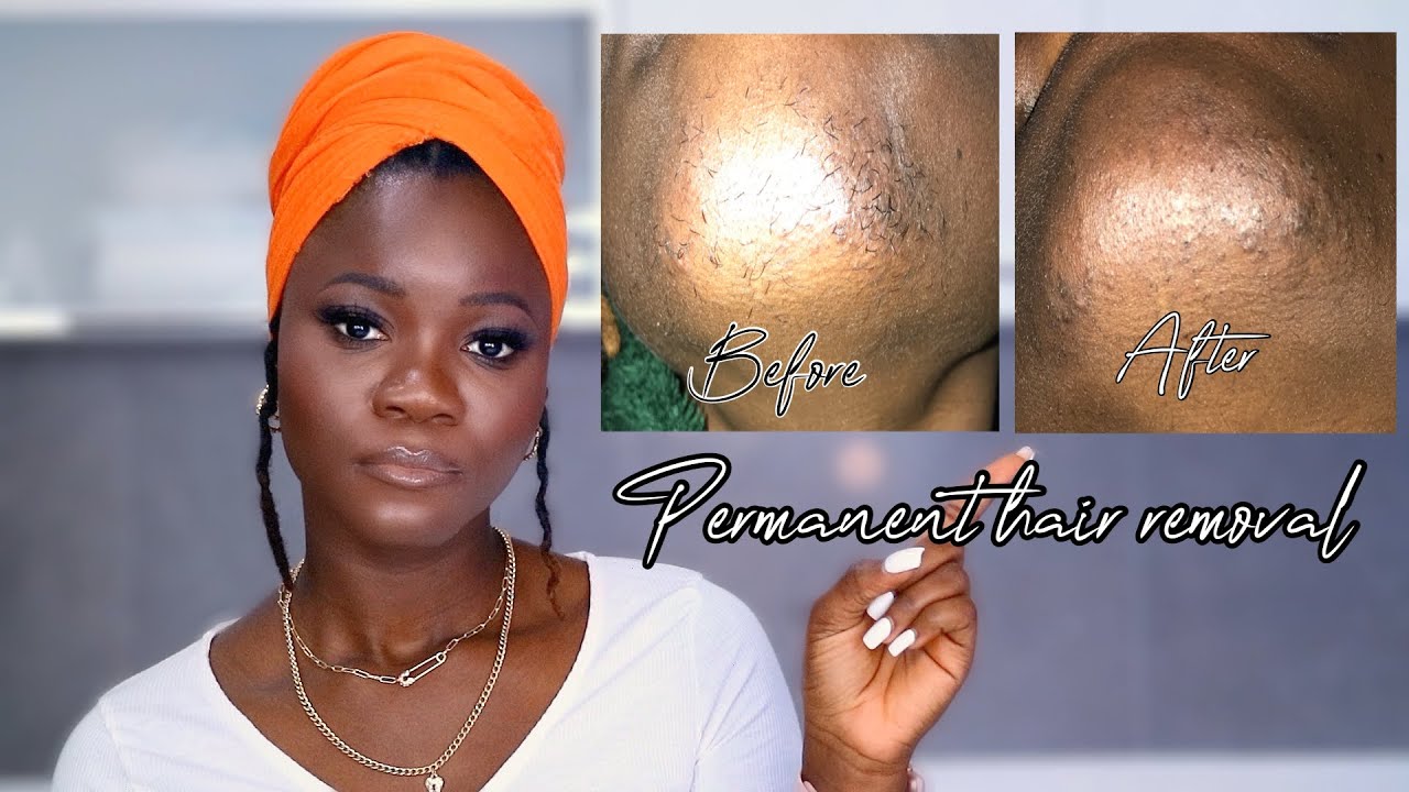 Update 1: My Electrolysis experience | Permanent hair removal | Electrolysis | Thatgirltameeza