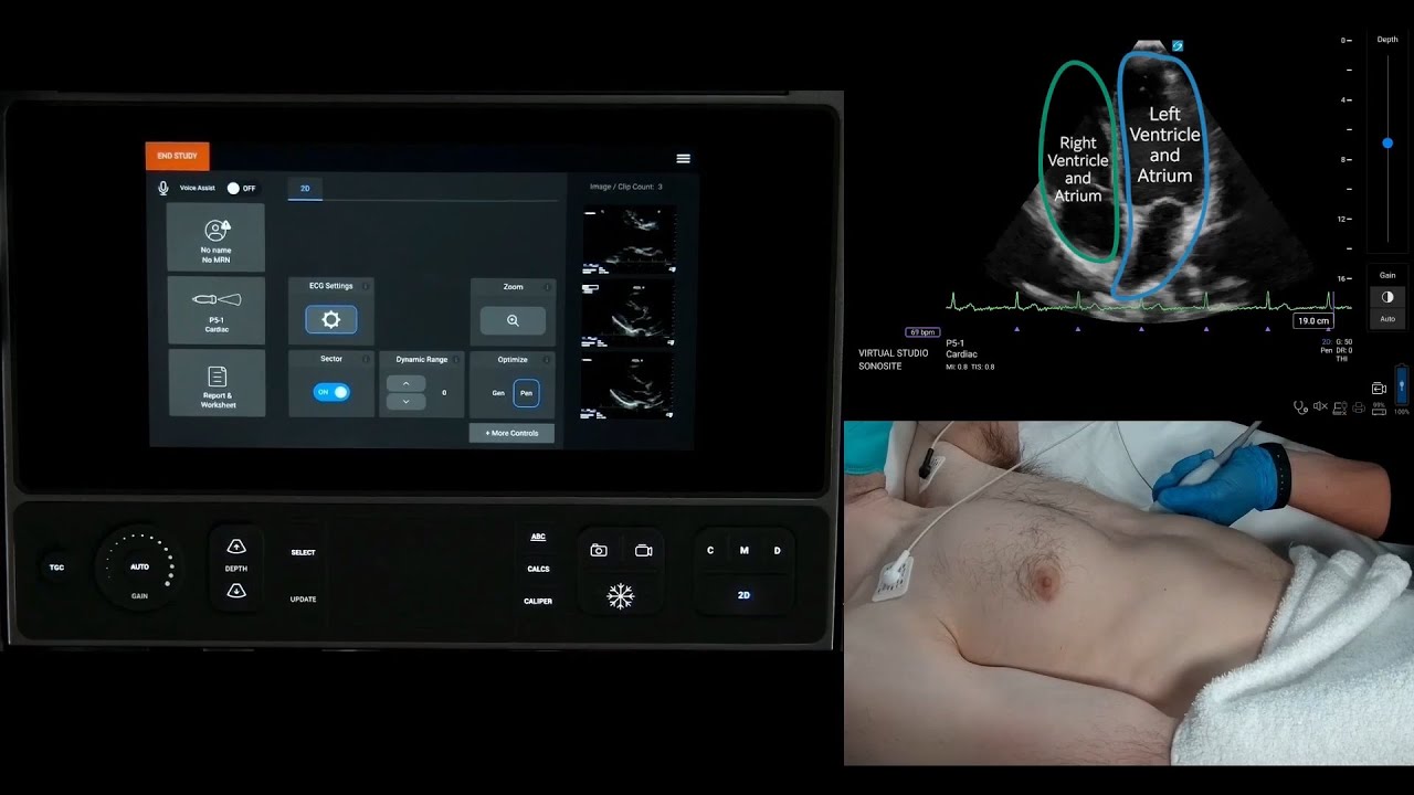 How-to Video: Assisted Cardiac Output Calculation with Sonosite LX and Sonosite PX
