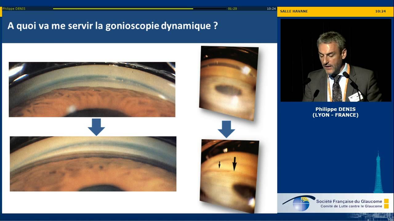 Hypertonie et uvéites - Pourquoi l’hypertonie ? (Philippe Denis)