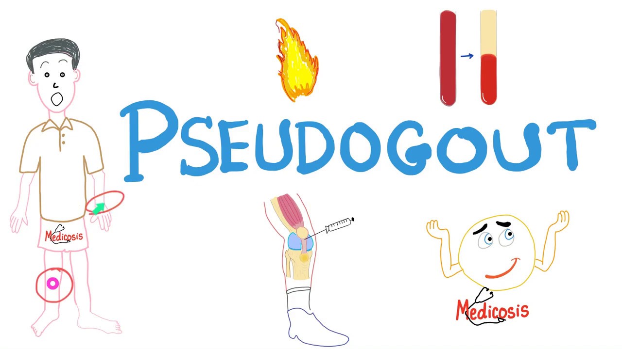 Pseudogout - CPPD Disease - Rheumatology