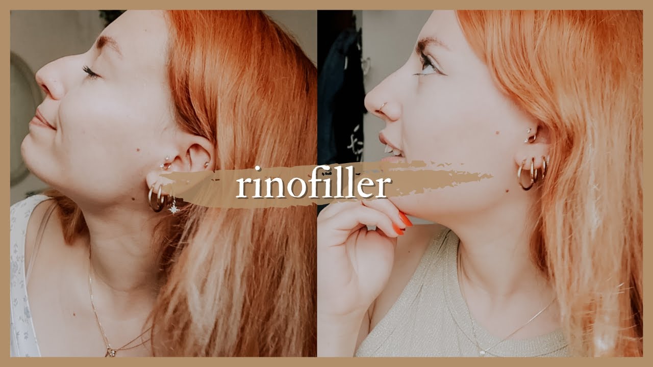 Ho fatto il FILLER al NASO (RINOFILLER) | vlog 👃🏻✨