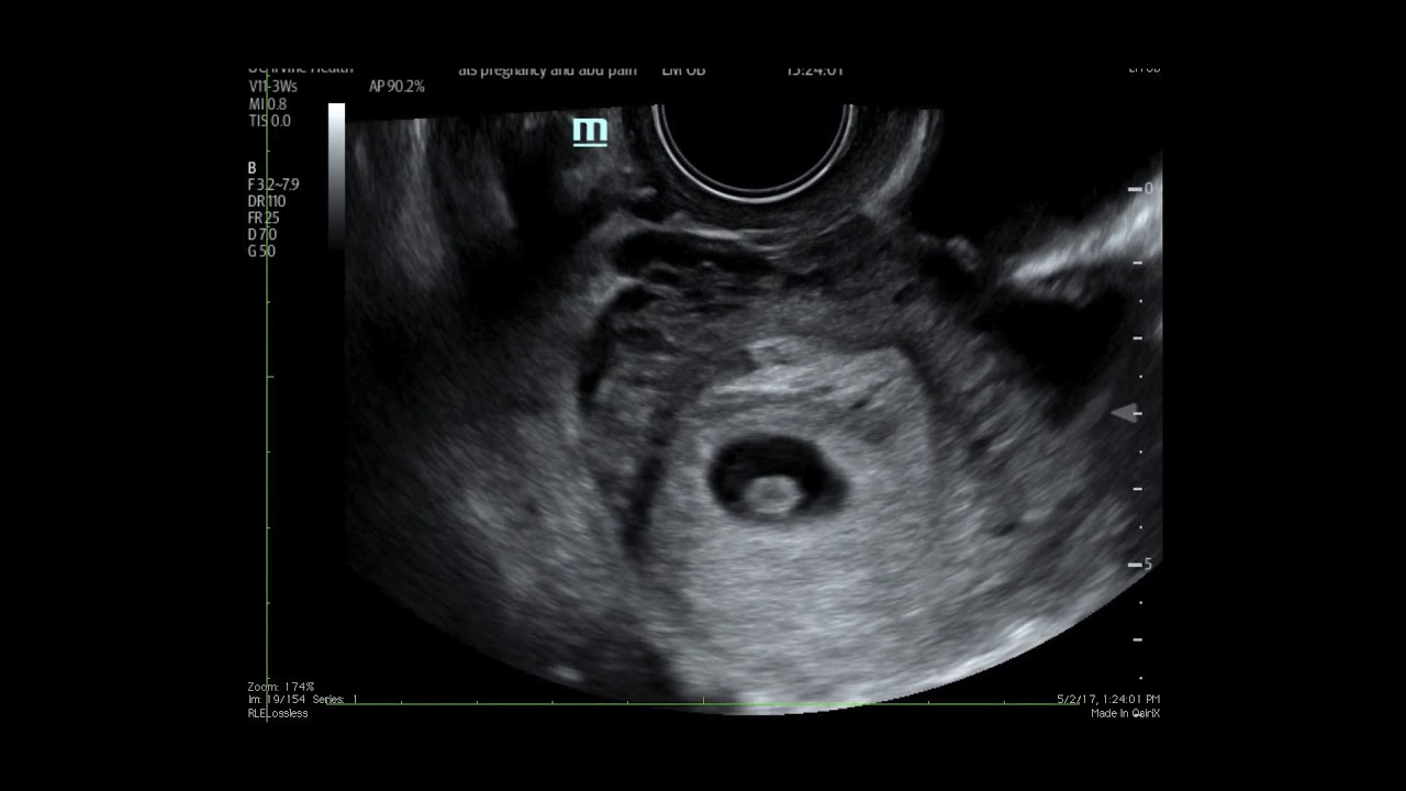 Tubal cyst with IUP. Ultrasound, annotated.  JETem 2018