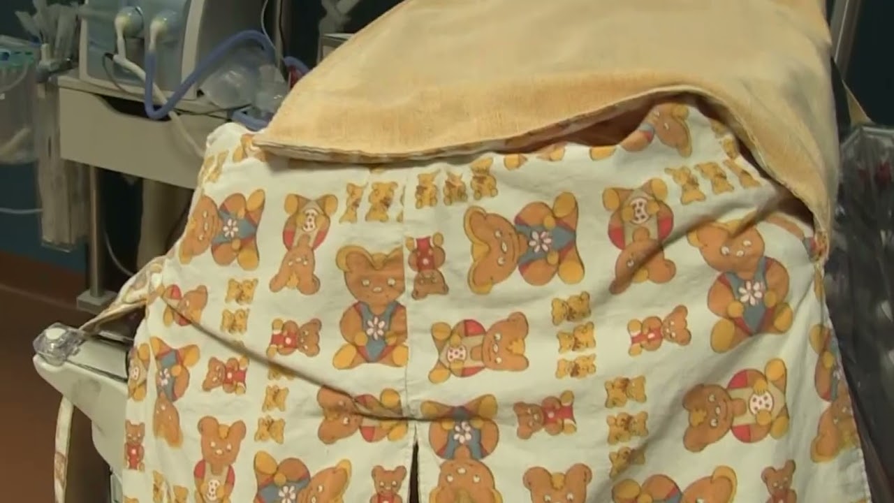 Parto gemellare rarissimo al Riuniti di Foggia: sorelline condividono sacco amniotico e placenta