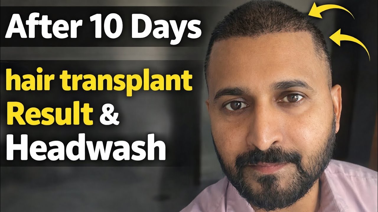 My Hairtransplant After Head Wash | Day -10 