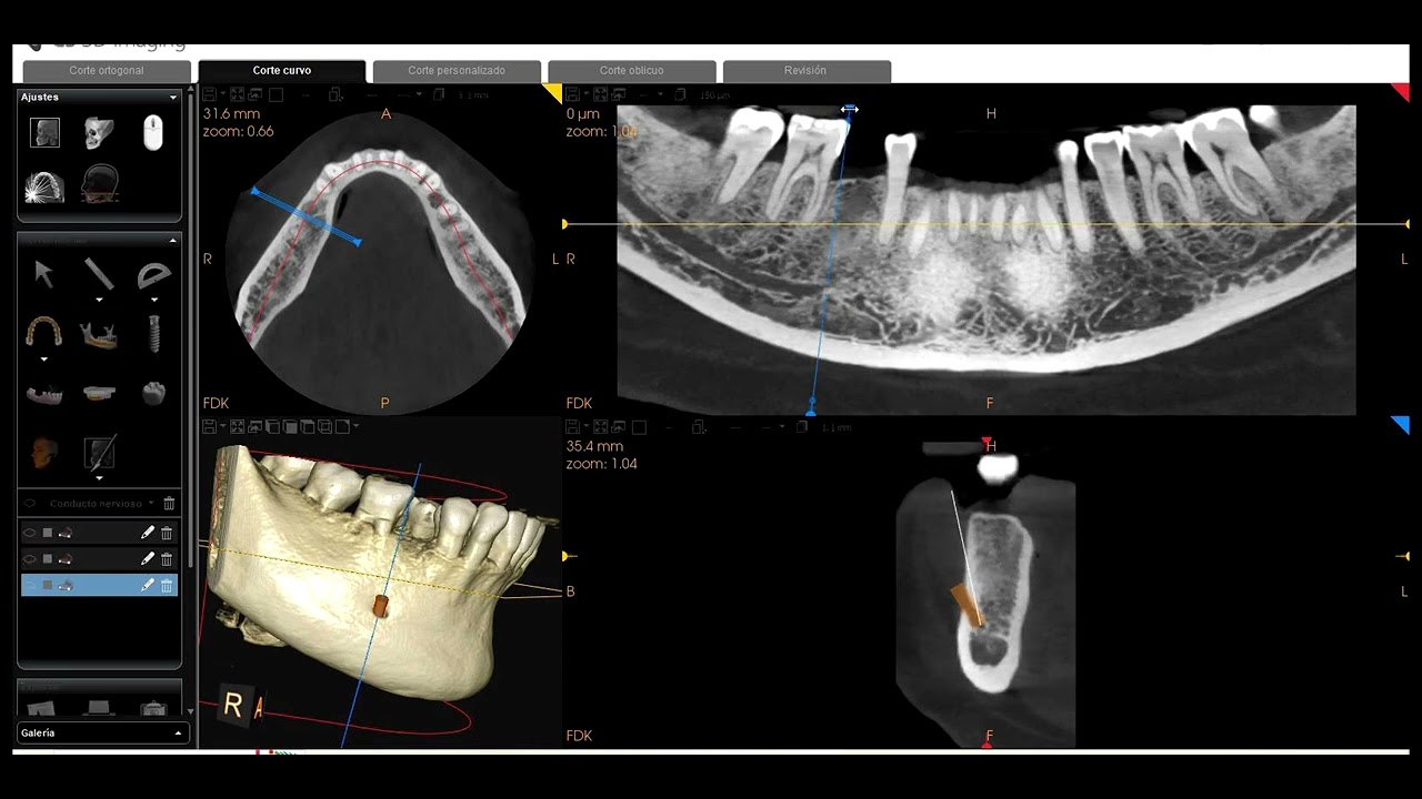 Cómo marcar el nervio dentario inferior