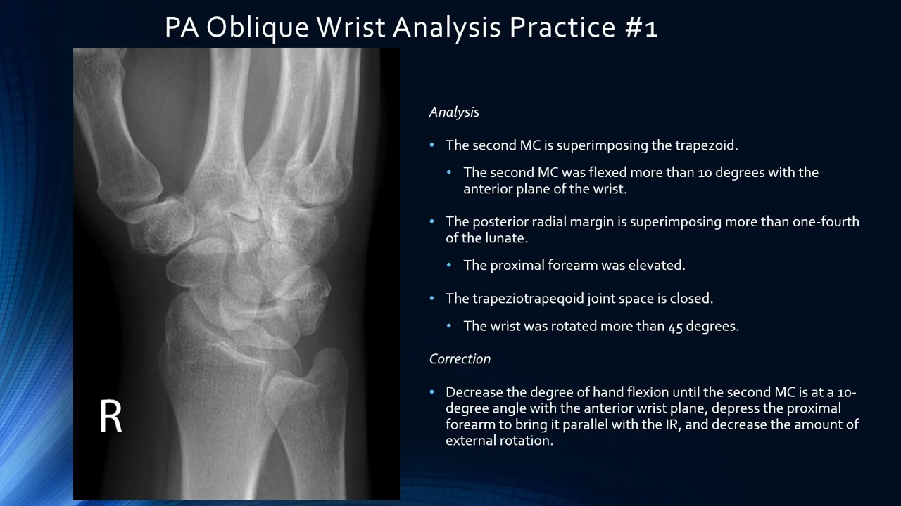 Image Analysis -Upper Extremity -Thumb, Wrist, Forearm, Elbow