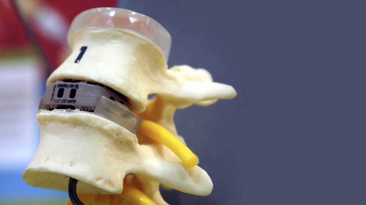 Spondilolistesi | Dott. Pietro Brignardello