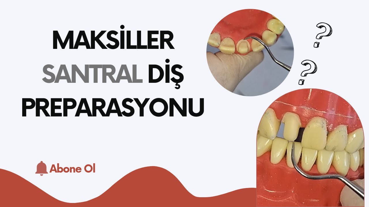 Maksiller Santral Diş Preparasyonu (Basamaklı Diş Kesimi)