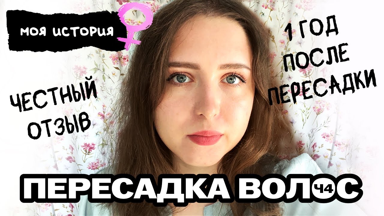 Год после пересадки волос. Честный отзыв. Результаты.