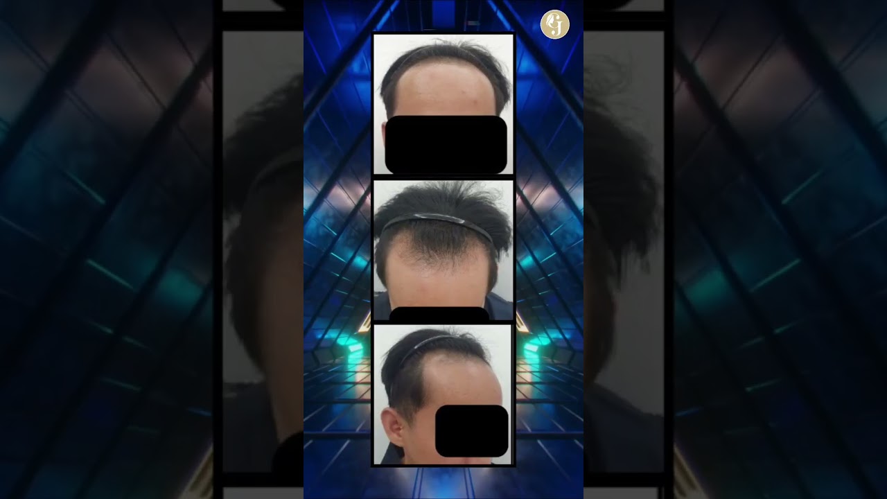 M-shape Hairline Transplant  