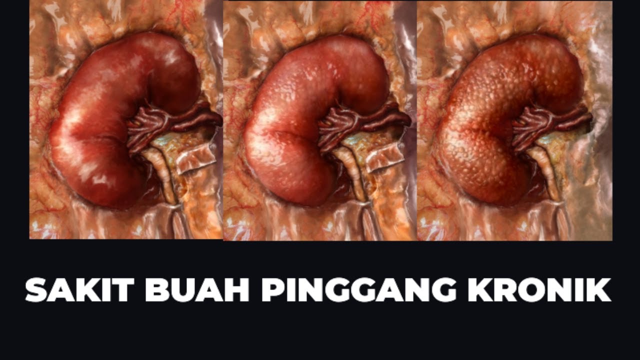 PENYAKIT BUAH PINGGANG KRONIK (PUNCA & RAWATAN)