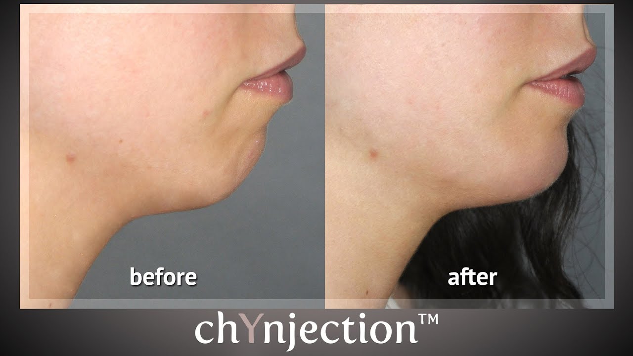 chYnjection&trade; by Dr. Yan Trokel