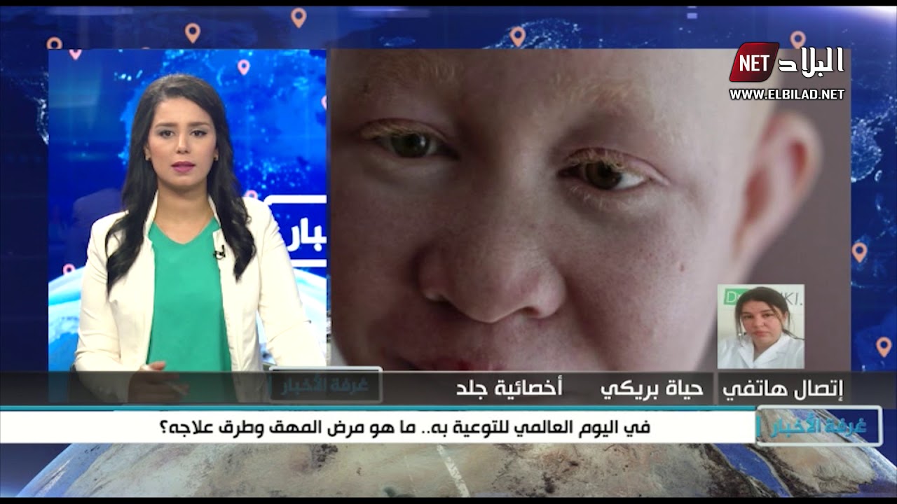 في اليوم العالمي للتوعية به.. ما هو مرض المهق وهل له علاج؟